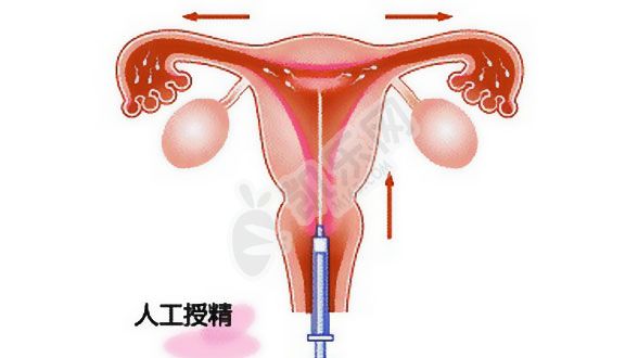 人工授精最好的10大生殖医院(图3)