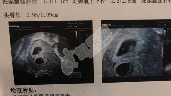 试管婴儿移植后几周看双胎（怀双胞胎的注意事项）(图2)