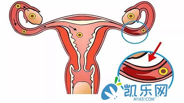 输卵管积水试管能成功吗?能不能治好?(图2)