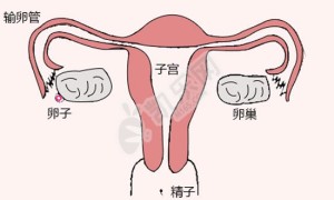 输卵管堵塞是复通还是试管婴儿好？